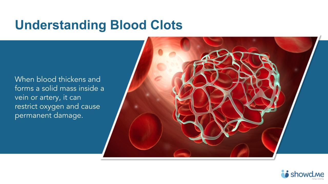 Recognizing and Preventing Blood Clots